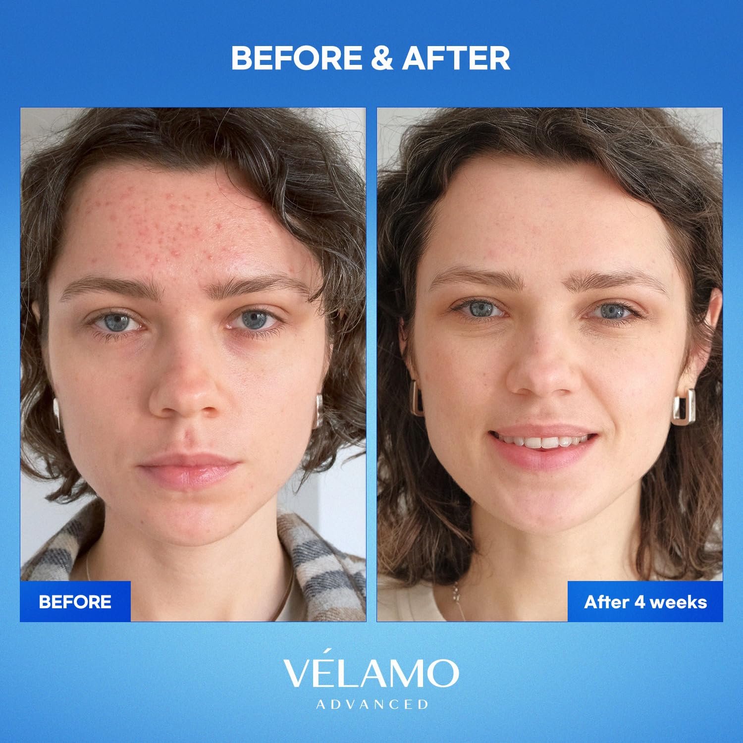 VELAMO ADVANCED Dark Spot Remover for Face and Body: Dark Spot Corrector Serum - Freckle/Melasma/Sun Spot/Age Spot/Brown Spot Remover 1 FL OZ/30mL - Image 5